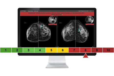 Examen de mammographies : résultat d&amp;#039;analyse par l&amp;#039;IA de Therapixel - ©&amp;#160;Therapixel